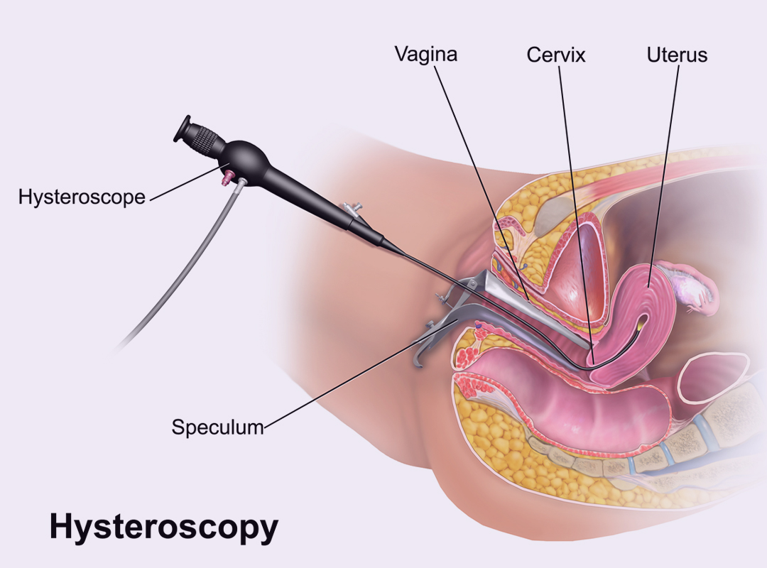 What is the Cost of Hysteroscopy in Chennai?